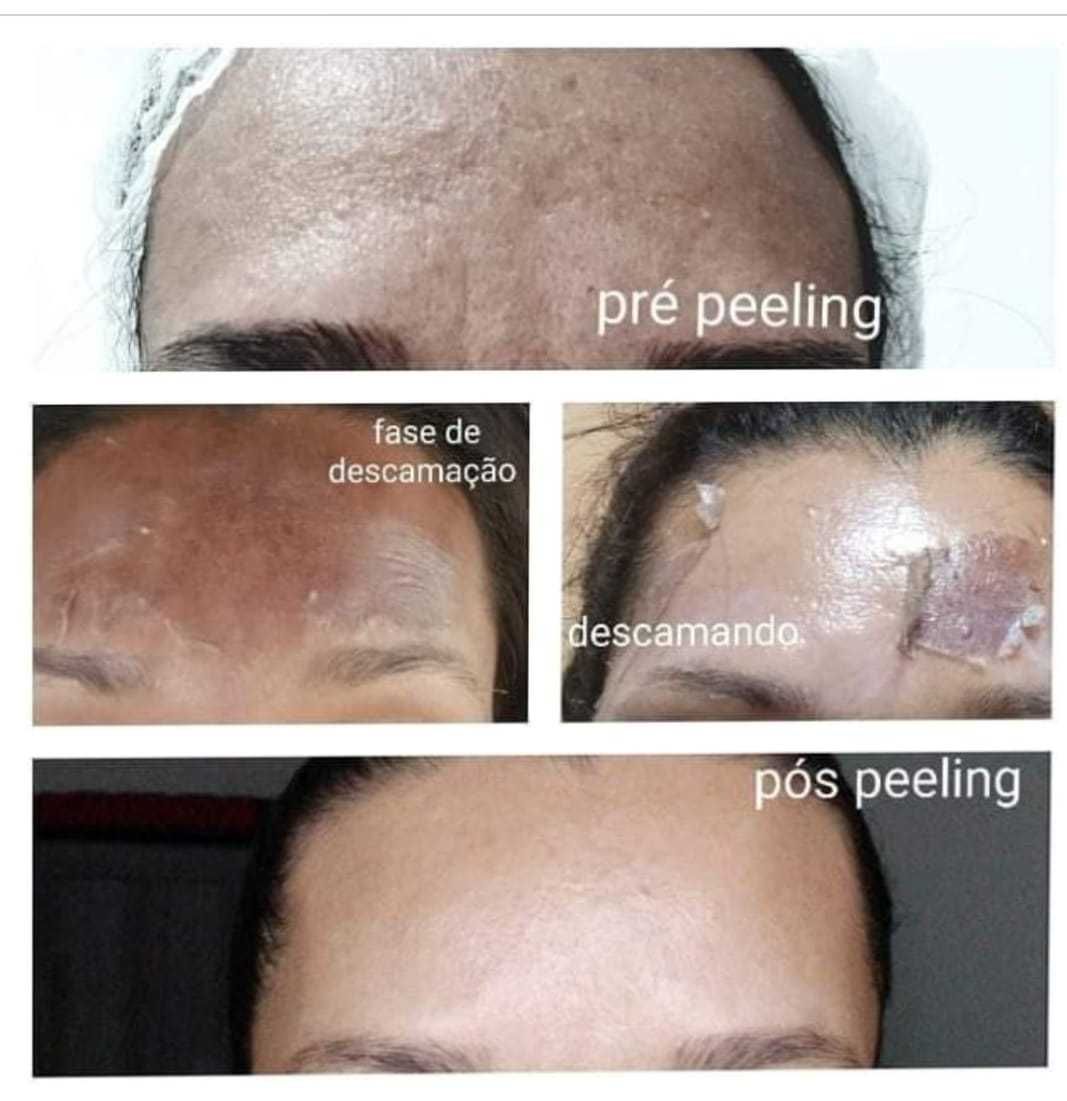 Peeling do Mar morto