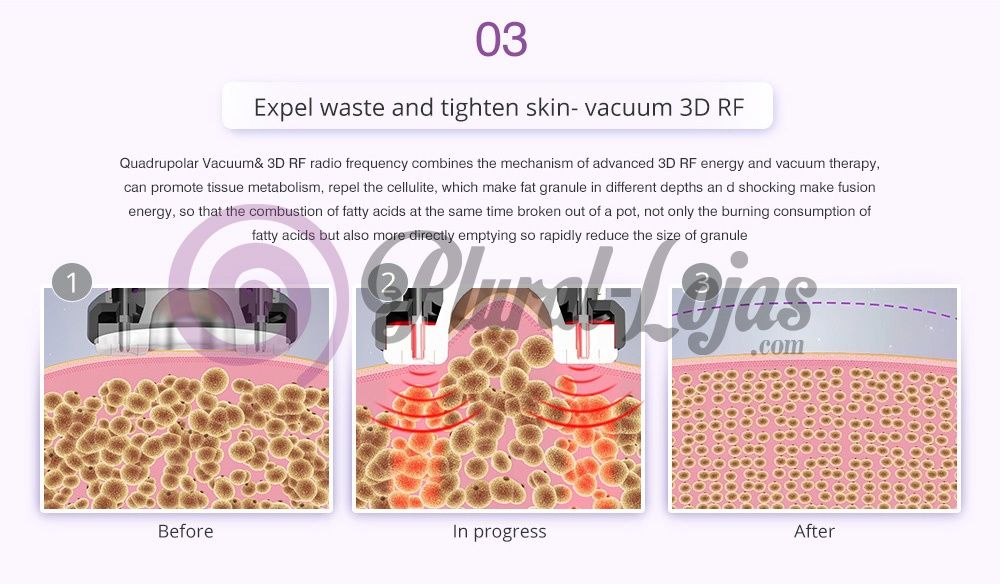 CAVITACAO  9 EM 1 - RADIOFREQUENCIA + VACUO+ LIPOLASER+CRIO