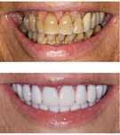 Implante dentario (400€)