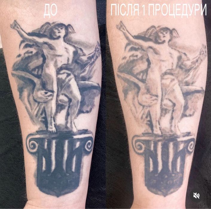 Скидка на безопасное Лазерное удаление тату/татуажа карбоновый пилинг