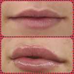 PROMOCJA botox powiększanie ust hialuronowy laser HIFU
