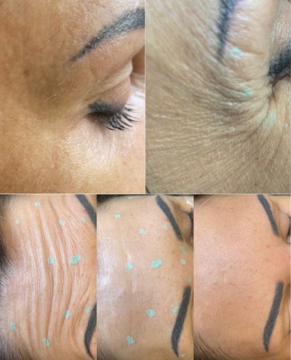 BTX , wygładzenie zmarszczek