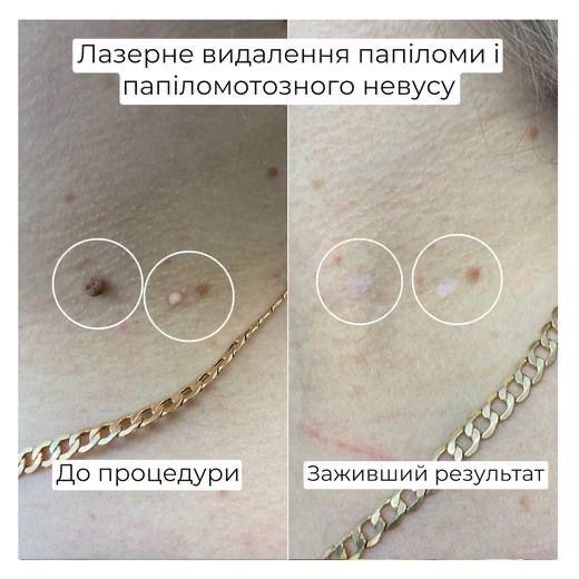 Лазерне видалення папілом