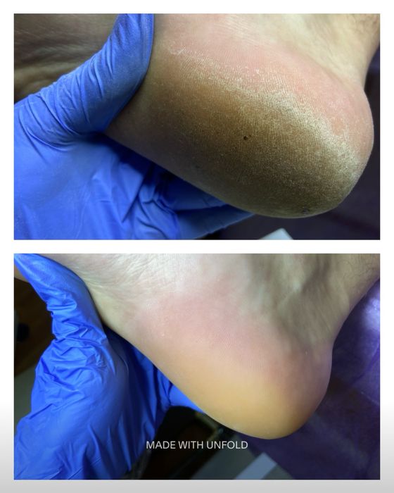 Подолог Харків, Центр. Подологічний педікюр