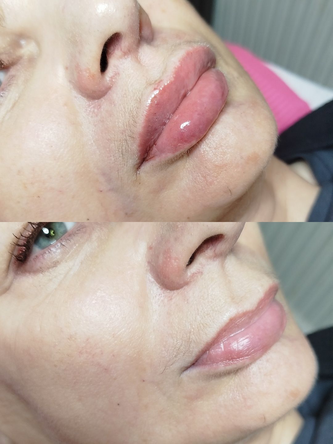Modelowanie i powiększanie UST - 400 zł. 1 ml.