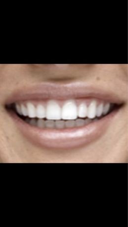 Чистка зубов ультразвук+аир флоу в 3 этапа всего за 499 грн.