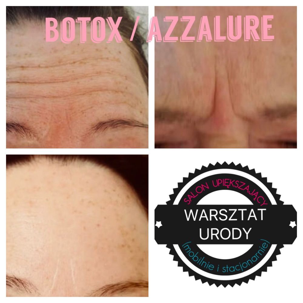 250zł= Botox - Botoks/ PLASMA IQ/ Wolumetria/ Powiększenie Ust -300zł
