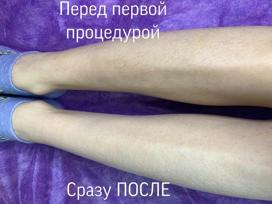 Електроепіляція Оболонь