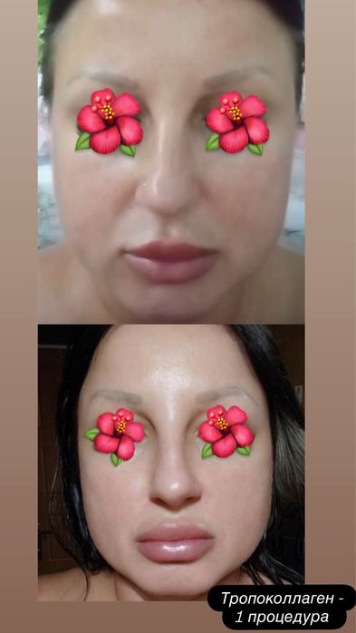 Косметолог Харьков.Ботокс 800 грн /зона