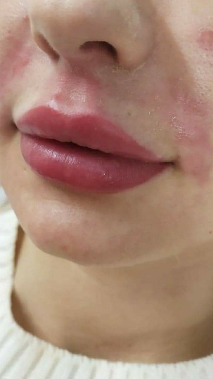 PROMOCJA botox powiększanie ust hialuronowy laser HIFU