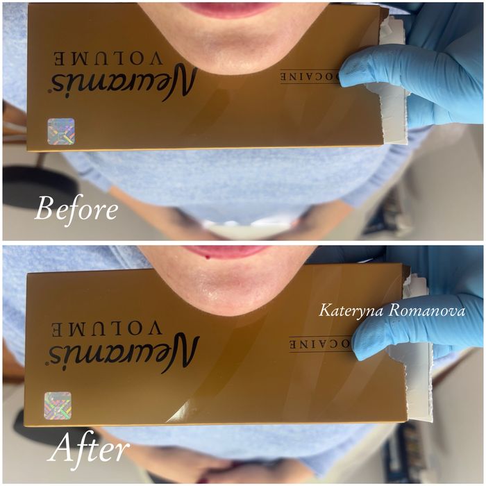 Безкоштовно збільшення губ / контурна пластика губ / ботокс