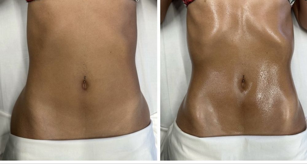 Emsculpt aparelho estético