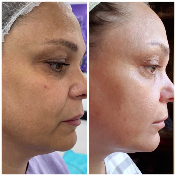 Холодна плазма НОВА розробка вчених Косметологічний апарат