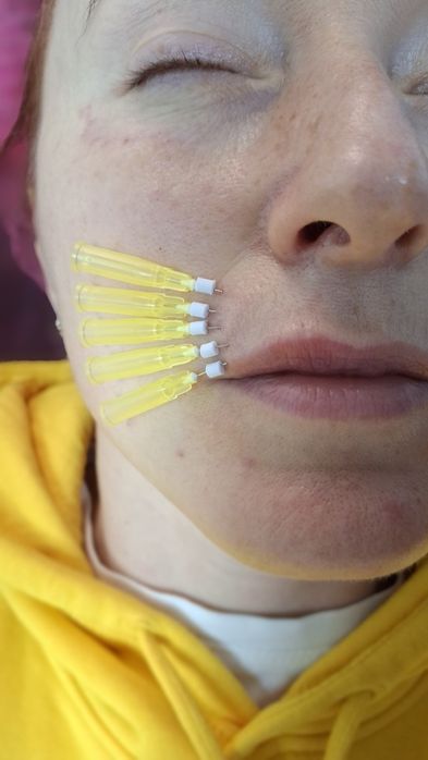 Косметолог,увеличение губ ,ботокс ,чистка лица ,пирсинг,мезотерапия