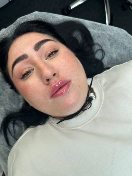 Збільшення губ,ботокс,мезотерапія,біоревіталізація,чистка обличчя