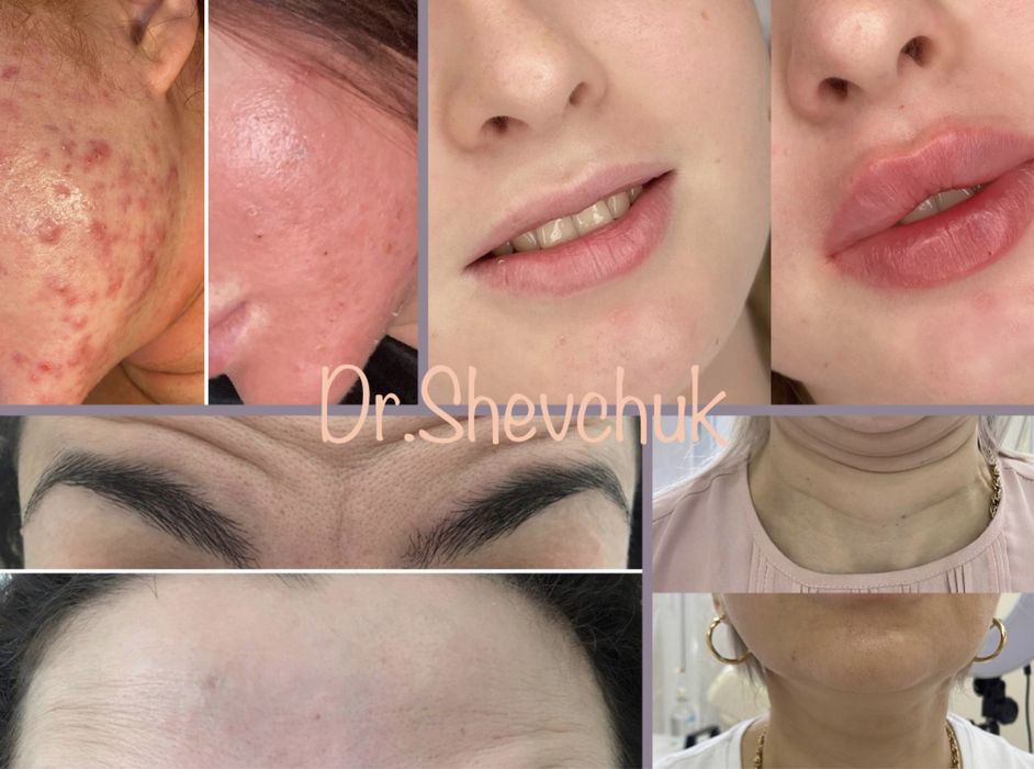 Лечение акне, врач дерматолог , врач косметолог.