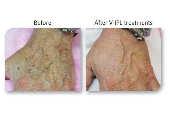 Laser Viora Medical, Radiofrequência bipolar e Fraccionada