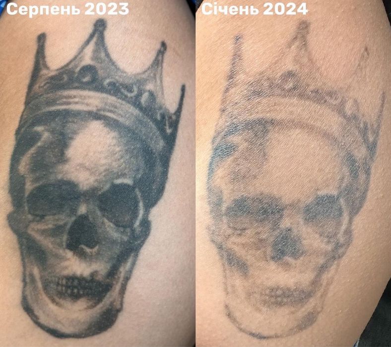 Скидка на безопасное Лазерное удаление тату/татуажа карбоновый пилинг