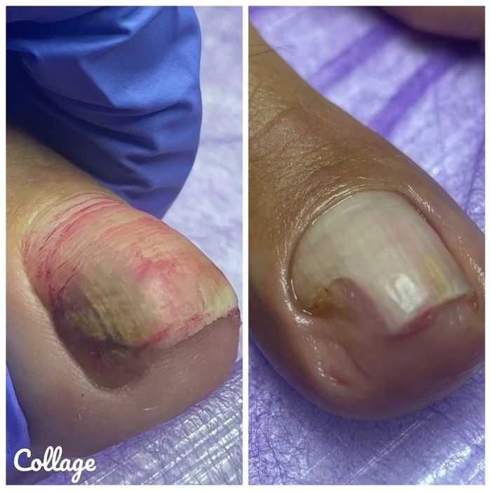 Подолог Харків, Центр. Подологічний педікюр