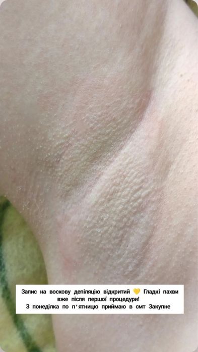 Запрошую на воскову депіляцію