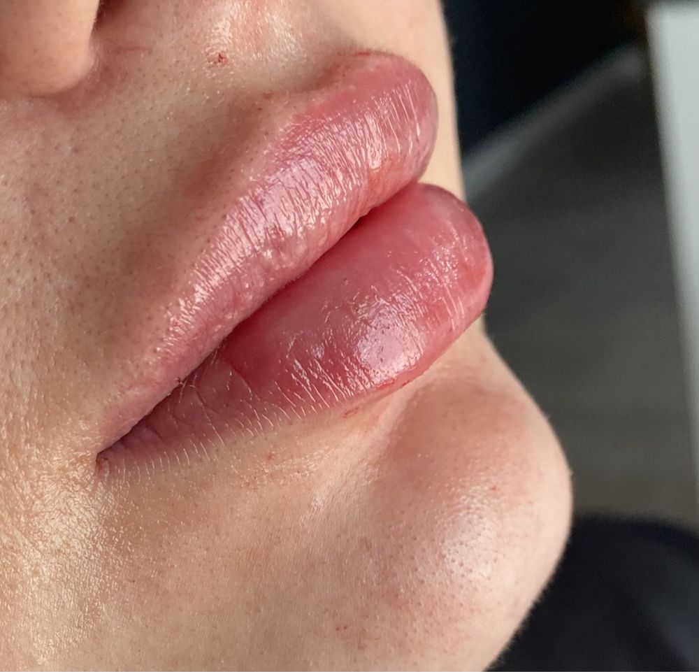 Powiększanie ust RUSSIAN LIPS 1ml 600zl, botox,dolina łez,volumetria