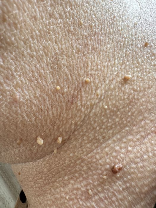 Usuwanie włókniaków, prosaków i zmian skórnych — dojazd do gabinetów