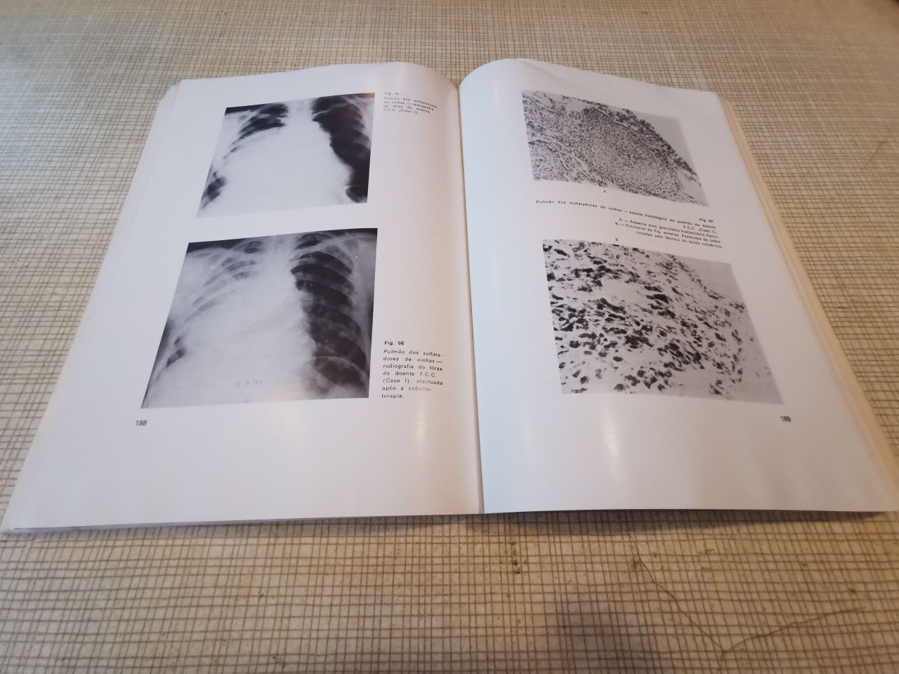 Livro Granulomatoses pulmonares