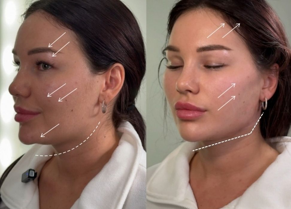 Usta 1ml od 300zł wypełniacz Premium, stymulatory, btx