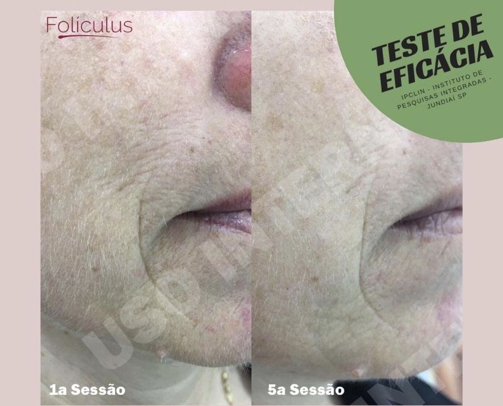 Novidade!!!Creme acelarador de depilação a laser