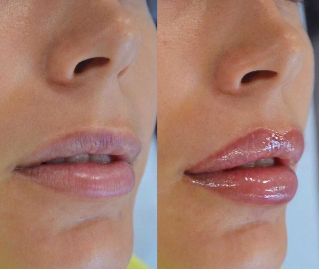 Современная косметология: увеличение губ, контурная пластика, Ботокс.