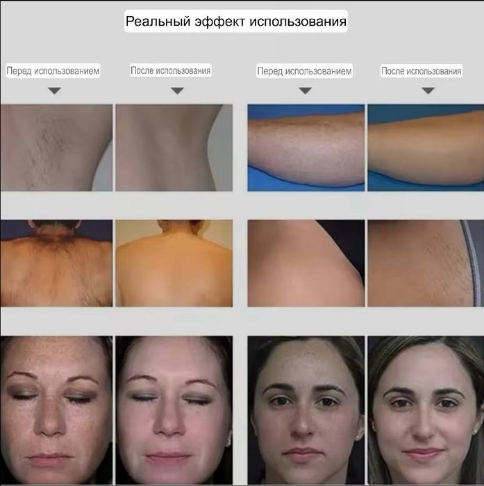 Професійний апарат IPL+OPT: епіляція та омолодження шкіри.