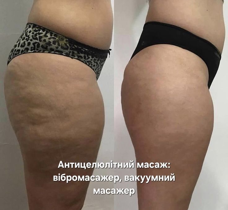 Антицелюлітний масаж