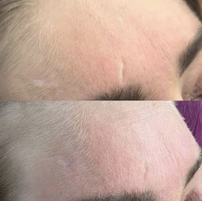 Мікроліндінг-Видалення шрамів-Рубці-Розтяжки