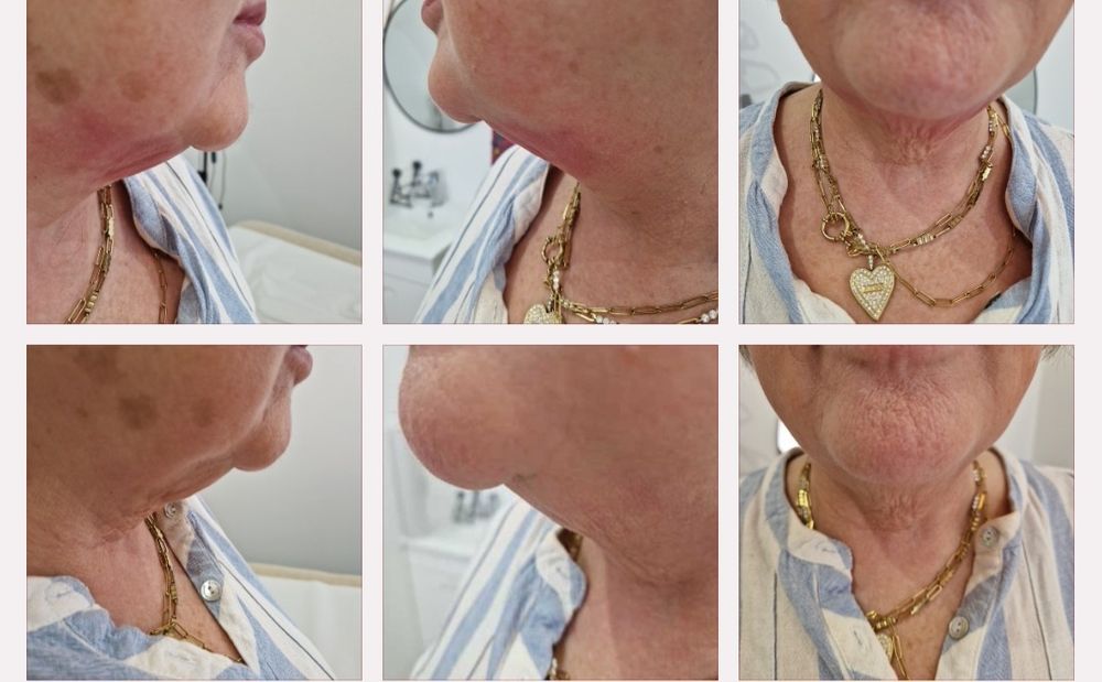 Hifu 22 rosto completo com pescoço e papada