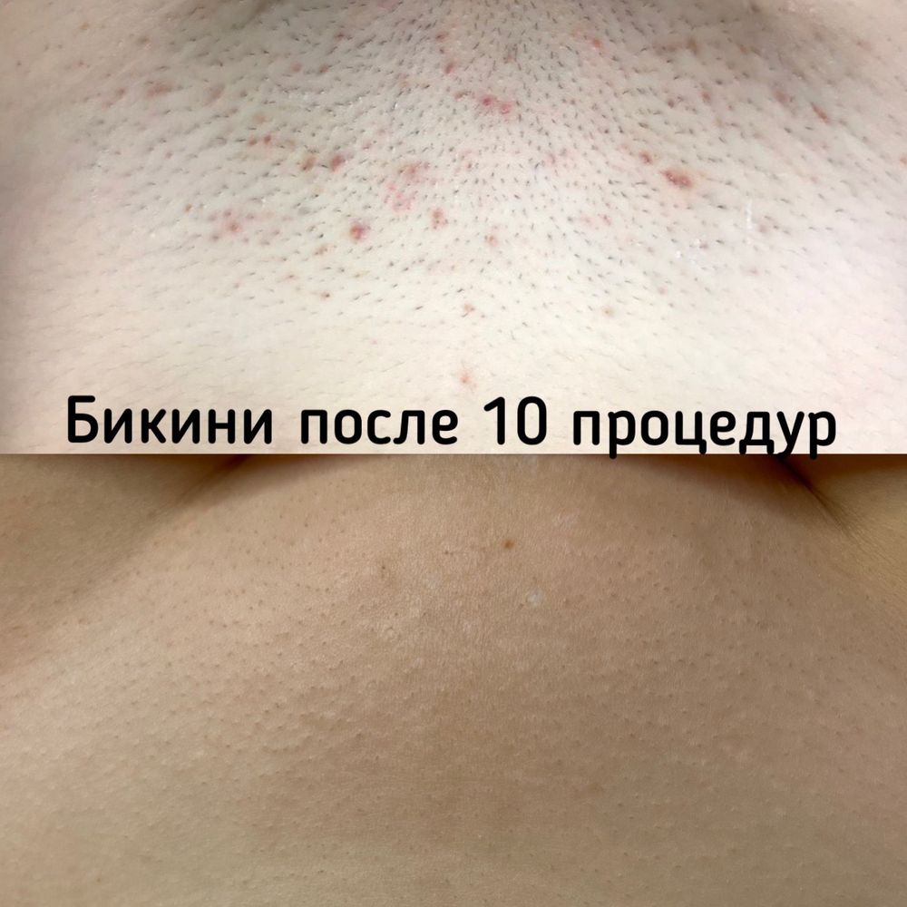 Лазерна епіляція, воскова депіляція, Геров Днепра, Оболонь