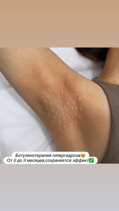 Ботокс.Увеличение губ.Гипергидроз