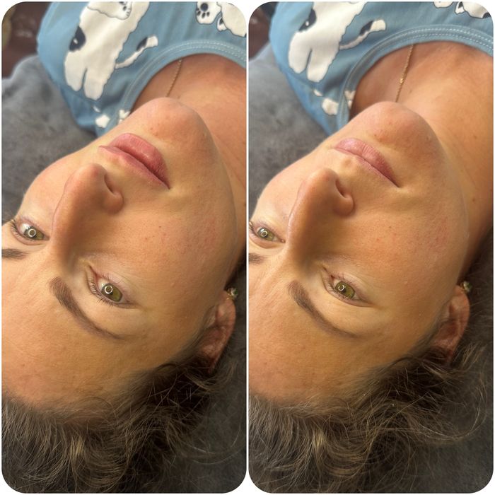 Увеличение губ и ботокс