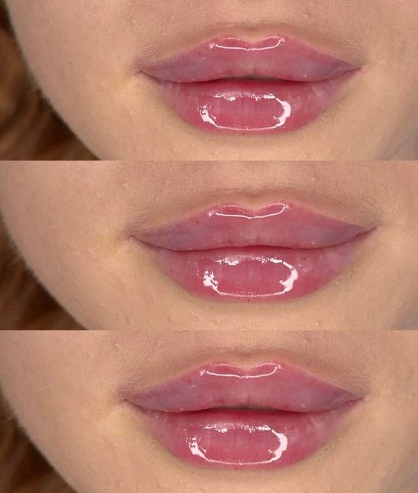 Usta 1ml od 300zł wypełniacz Premium, stymulatory, btx