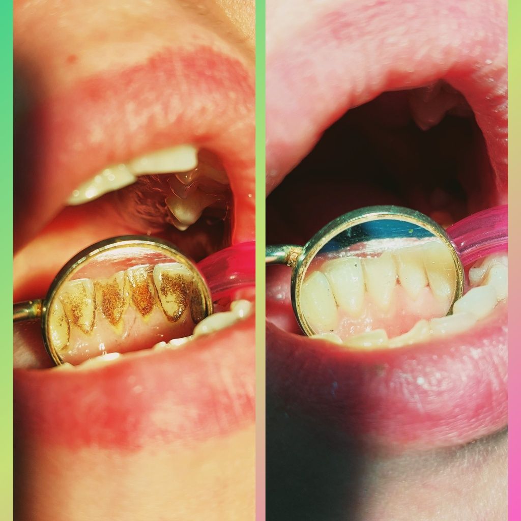 Лечение зубов Стоматолог