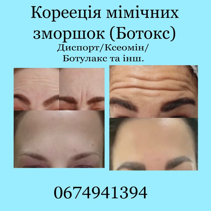 Послуги косметолога збільшення губ Ботокс Диспорт