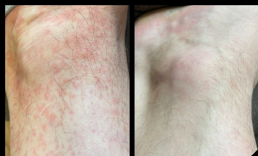 Дерматолог. Венеролог.Диагностика(анализы+УЗД).Лечение.Наблюдение