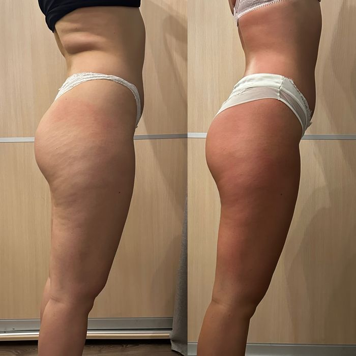 Антицеллюлитный массаж