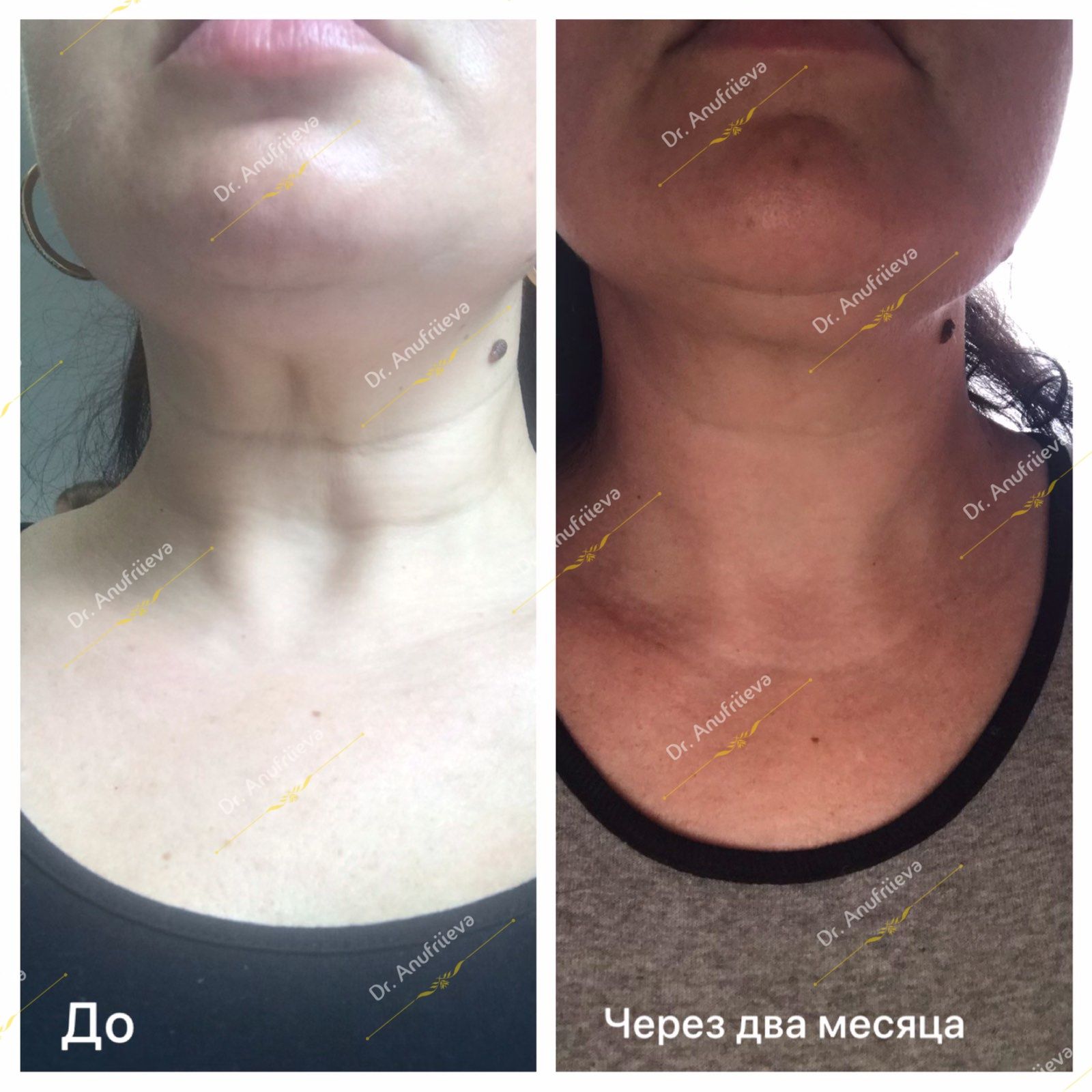 Увеличение губ, ботокс, мезотерапия, биоревитализация. Киев