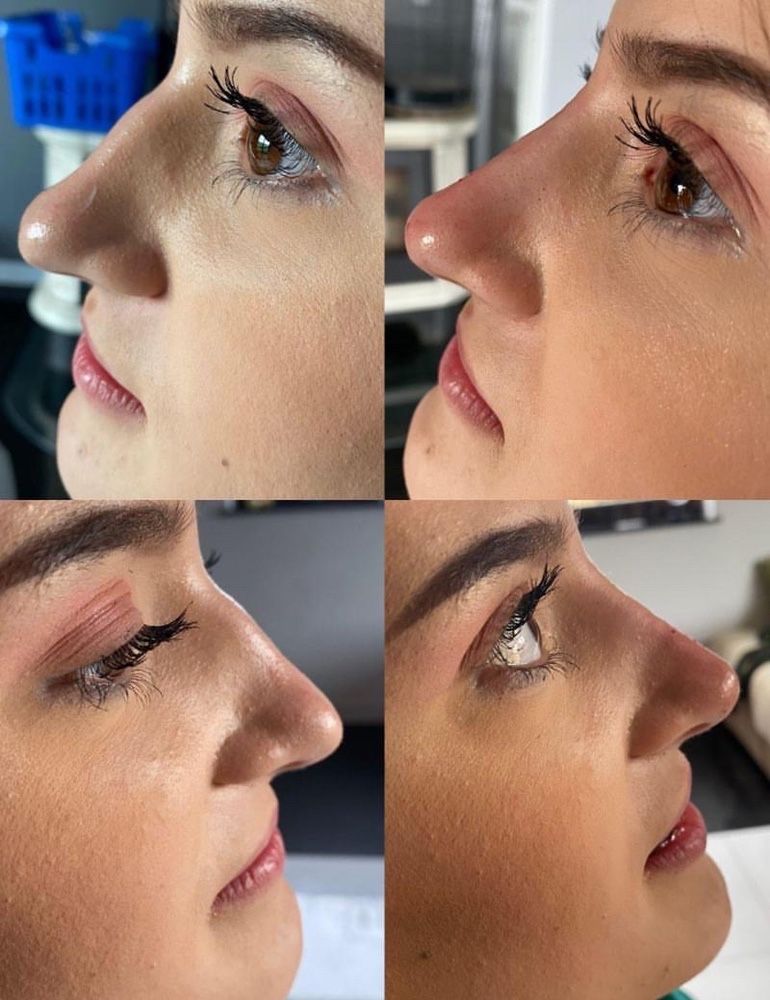 Powiększanie  ust Russian Lips 1ml 600zl ,botox , volumetria twarzy
