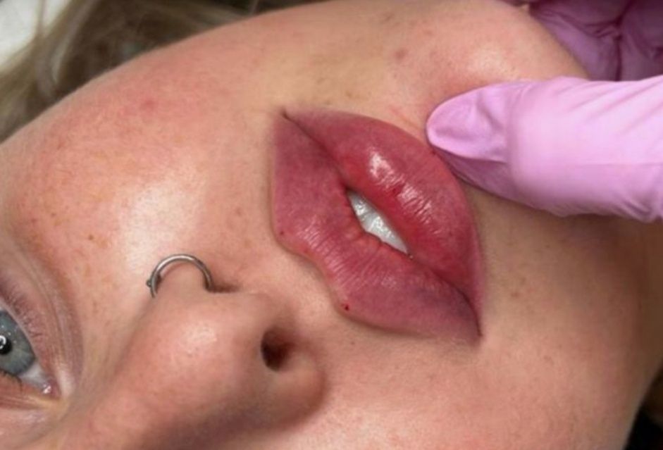 Увеличение губ - 1600. Колличество мест ограничено!