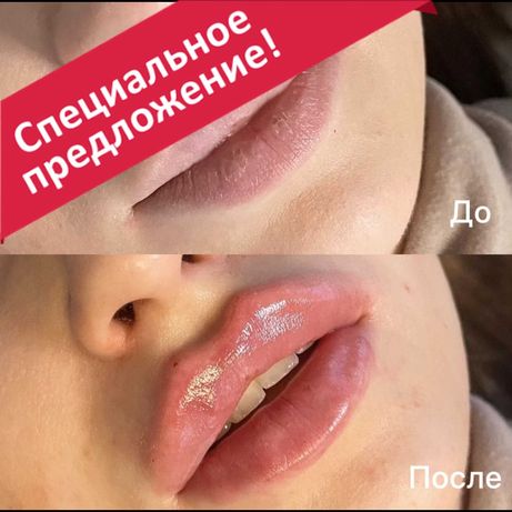 Увеличение губ, ботокс, биоревитализация, мезотерапия, косметолог Киев