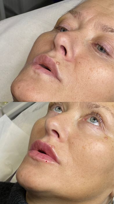 Шукаю моделей на контурну пластику губ,препарати тільки сертифіковані