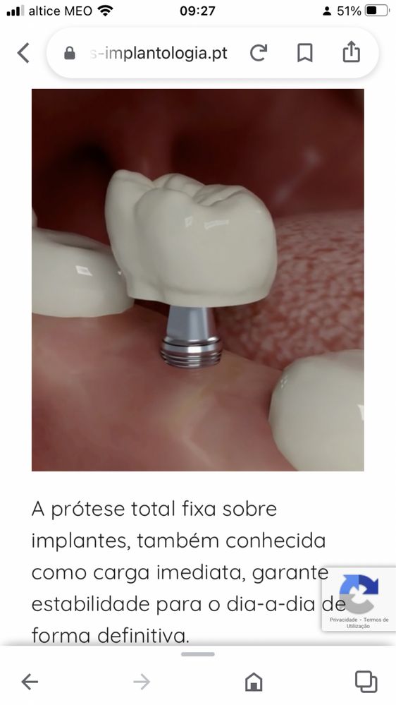 IMPLANTES DE DENTES   em várias tranches        varios pagamentos um  sorriso e expressao facial de excelência