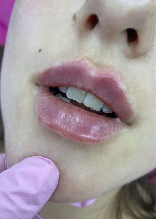 Акція з 17-30.12 -15% Контурна пластика обличчя, ботокс