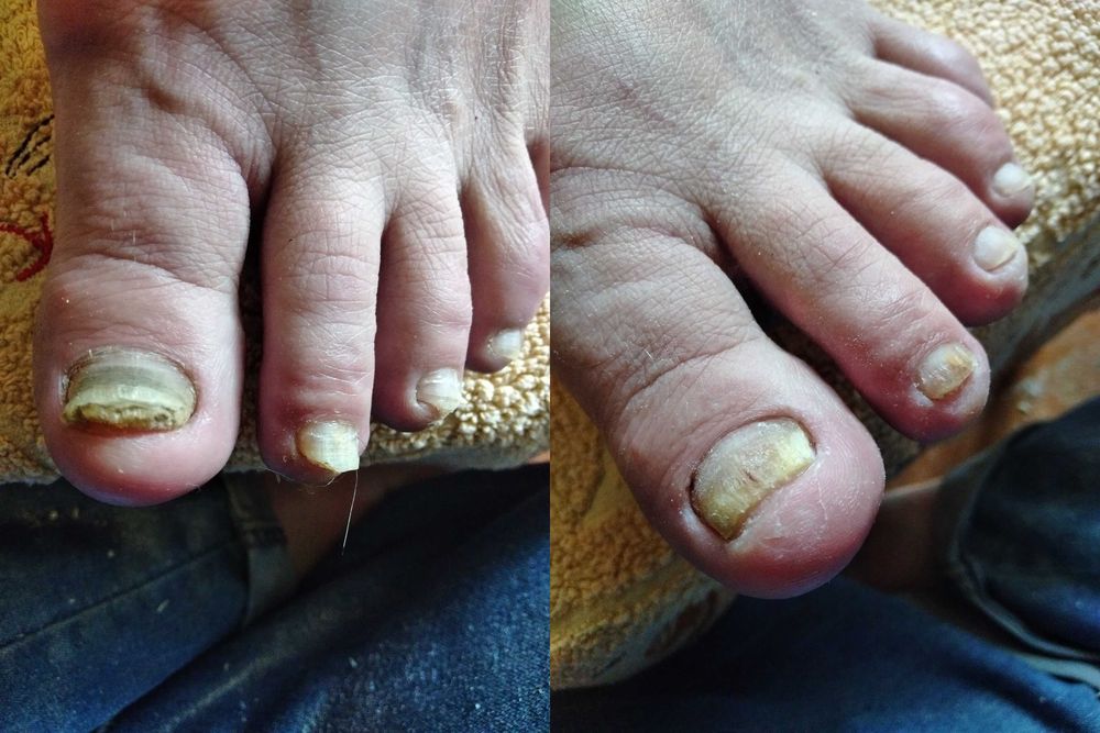 Подолог с Выездом на Дом для стариков,вросший ноготь,грибок,Медпедикюр